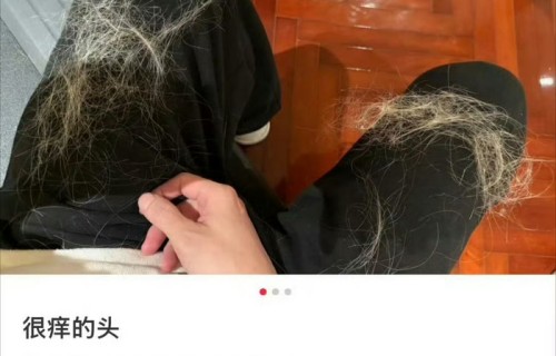 薛之谦被曝满头斑秃水泡，粉丝称其状态仍佳|诚意