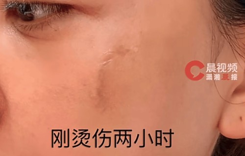 呀,杨蓉大方晒烫伤恢复照哦,她怎么看待脸上那点小疤痕呀?|童年|表情包|写真|滤镜|痘印